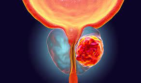 Symptoms often become apparent when your prostate. Prostate Cancer Symptoms Doctors Tests For Disease Revealed Express Co Uk