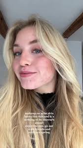 i know it’s a rollercoaster of feelings but life is too short to always  worry about what others could think of you/ your skin condition. acne  doesn’t define you #acne #skincondition ...