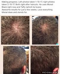 The majority of androgenetic alopecia (or male pattern baldness) sufferers start noticing their hair loss in their mid to late twenties. Black Men Hair Regrowth