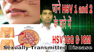 Because of the euphemisms we've attached to hsv1, people assume that oral herpes is a mild infection, occasionally bothersome, but never dangerous. Infection Of Herpes Simplex Virus Ii Hsv 1 And Hsv 2 Ii Igg And Igm Antibodies In Hindi Youtube