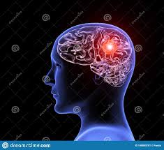 Cela peut également occasionner des troubles soudains de la vue ou de la parole. Migraine Humaine De Mal De T Te Illustration Stock Illustration Du Neurologie Diagnostic 148809701