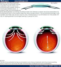 Medscape Log In Cataract Surgery Cataract Symptoms Cataract