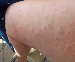 But depending on its underlying cause. Rashes Could Be Key Sign Of Covid 19 Here S What They Look Like Huffpost Uk Life