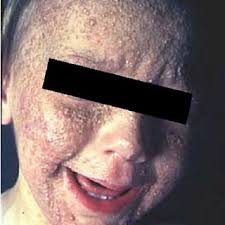 A few cases of intentional human poisoning have also been reported. President Viktor Yushchenko Of Ukraine Before And After Dioxin Download Scientific Diagram