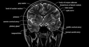 Brain Anatomy Mri Coronal Brain Anatomy Free Mri Cross Sectional Anatomy Mri Brain Brain Anatomy Mri