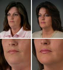 как сделать лицо чистым и гладким в домашних условиях Before And After Photos Of Flexaway System User Rids Double Chin Youthful Mouth Restored Sculpted Face And Neck Muscl Facial Exercises Neck Exercises Beauty