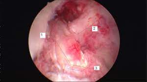 Maybe you would like to learn more about one of these? Anterior Cruciate Ligament Reconstruction Wikipedia