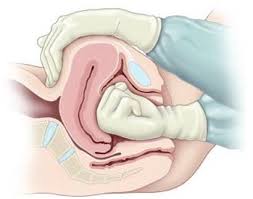 Image result for Active Management of Labor