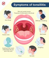 Image result for Tonsillitis