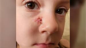 Mom says 4-year-old needed stitches after classroom incident in Cambridge,  Ont.