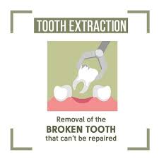 Teeth Are Fun Extractions Are The Way To Go When A Tooth Has To Go Holistic Dentist Paige Woods Holistic Dentist Dentist Dental Facts
