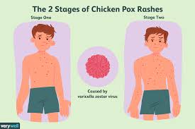 chickenpox symptoms causes diagnosis and treatment