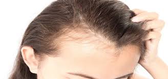In some cases, hair loss can be reversible with proper treatment. Reason For Hair Loss In Teens Girls Vibra Clinic