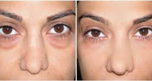 Title abstract author all doi. Une Ancienne Recette Au Bicarbonate De Soude Pour Faire Disparaitre Les Cernes Eye Bags Dark Circles Undereye Treatment