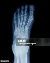 Image result for Foot XRay