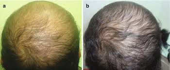 A collagen deficiency can be especially damaging to men and women who have started to see signs of hair loss. Nutritional Correction For Hair Loss Thinning Of Hair And Achieving New Hair Regrowth Springerlink