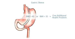 Who Is A Good Candidate For Gastric Sleeve Surgery