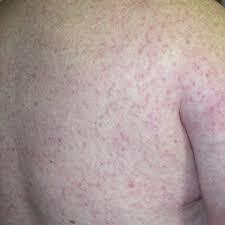 Most rashes are caused by common viral infections, and are nothing to be worried about. Pdf Clinical Manifestations And Outcomes Of West Nile Virus Infection