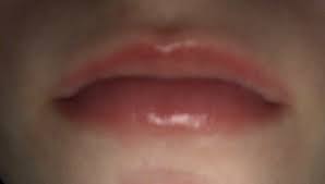 Was Hilft Gegen Rote Brennende Lippen Gesundheit Und Medizin Schmerzen Lippe
