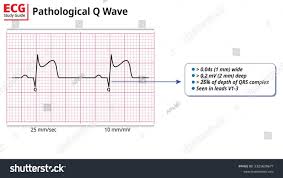 Image result for Q Wave