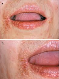 Check out our windburn lips selection for the very best in unique or custom, handmade pieces from our shops. Labiolingual Diseases Springerlink