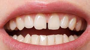 A tooth coloured resin is applied to your teeth and shaped to match their natural look. Ways To Fix Gap In Front Teeth Smile Angels Of Beverly Hills