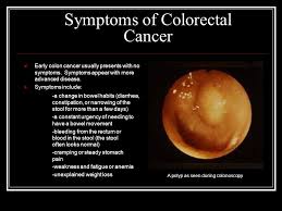 With rectal cancer, diarrhea is quite common. Colorectal Cancer Ppt Download