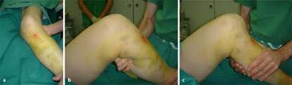This is inserted into the actual surgery in the operating area and pulled again after about. Isolierte Und Kombinierte Kniebandverletzungen Springerlink