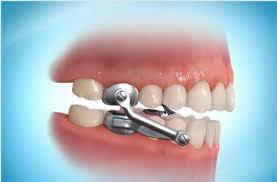 Is there an association between periodontitis and obstructive sleep apnea? Herbst Or Mara Appliances Van Westen Orthodontics Elm Grove Wi