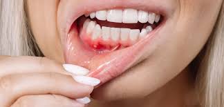 Image result for Periodontal Abscess
