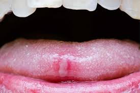 Image result for brown tongue symptoms