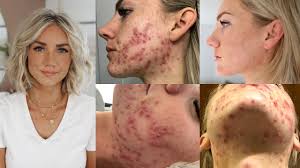 Don't underestimate this as a cause. How I Cured My Adult Hormonal Cystic Acne Naturally No Accutane Youtube