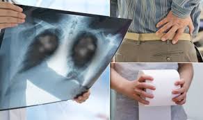 The exact cause of lung cancer is still being investigated. Lung Cancer Symptoms Four Surprising Signs Of Lung Cancer You May Not Expect Daily Star Post