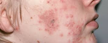 Hi, i am currently 20 and suffering from recurring pimples together with large painful cystic pimples with reddish scars under my skin even when the possibility of the acne recurring at the same spot once treated i would say is very low. Everything You Need To Know About Treating Cystic Acne