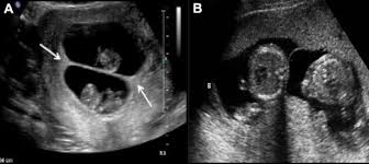 Lambda (as c) is a constant, often a real its a constant sign, this alphabets always don't give you a single information, it varies from field to field. Pitfalls In Assessing Chorioamnionicity Novel Observations And Literature Review American Journal Of Obstetrics Gynecology