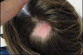 Black dye doesn't damage natural hair very much by itself, thankfully. Scarring Alopecia From Hair Dyes Highlights And Bleach Donovan Hair Clinic