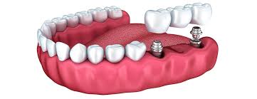 How much does insurance pay for dental implants? Dental Implant Cost Dental Implants Guide Dental Costs Australia