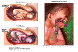 Meconium Aspiration Syndrome Mas Nursing School Survival Pediatric Nursing Nursing Study