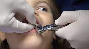 Sunshine Gets Her Tooth Pulled By The Dentist With Novocain Is She Afraid Youtube