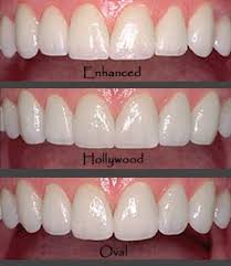 Digital Smile Design By Best Cosmetic Dentist In Beverly Hills Dr J Digital Smile Design Smile Design Cosmetic Dentist Cosmetic Dentistry
