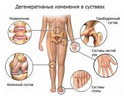 как избавиться от боли в тазобедренном суставе в домашних условиях Pin On Hitrosti Zhizni