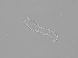 Image result for Urinary Cast