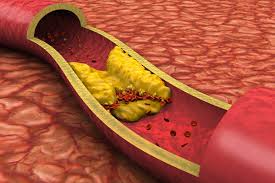 Image result for Lyme Carditis