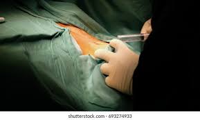 Image result for Local Skin Anesthesia