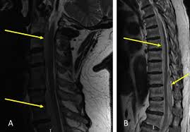Image result for Spinal Epidural Abscess