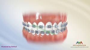 If you need rubber bands, small hooks or buttons will be strategically placed at various parts of your braces. Rubber Bands Ava Orthodontics Invisalign