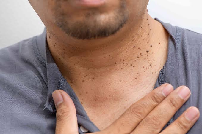 Skin Tag Removal in Islamabad - ARB Clinic