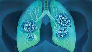 How long does it take for cancer to spread. Lung Cancer S Timeline How Fast Does It Grow Lung Cancer Center Everyday Health