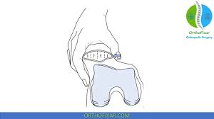 Image result for Patellar Tilt Test