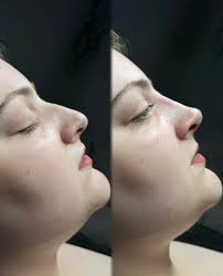 𝙏𝙝𝙚 𝙣𝙤𝙨𝙚.. 𝙩𝙝𝙚 𝙛𝙤𝙘𝙪𝙨 𝙥𝙤𝙞𝙣𝙩 𝙤𝙛 𝙩𝙝𝙚 𝙚𝙣𝙩𝙞𝙧𝙚  𝙛𝙖𝙘𝙚 💉 𝖡𝗒 𝖺𝖽𝖽𝗂𝗇𝗀 𝗌𝗆𝖺𝗅𝗅 𝖺𝗆𝗈𝗎𝗇𝗍𝗌 𝗈𝖿 𝖽𝖾𝗋𝗆𝖺𝗅  𝖿𝗂𝗅𝗅𝖾𝗋 𝗍𝗈 𝗌𝗆𝗈𝗈𝗍𝗁𝖾𝗇 𝗈𝗎𝗍 𝗍𝗁𝖾 𝖽𝗈𝗋𝗌𝖺𝗅 𝗁𝗎𝗆𝗉  𝗐𝗁𝗂𝖼𝗁 𝗂𝗌 𝗍𝗁𝖾 𝖻𝗋𝗂𝖽𝗀𝖾 ...